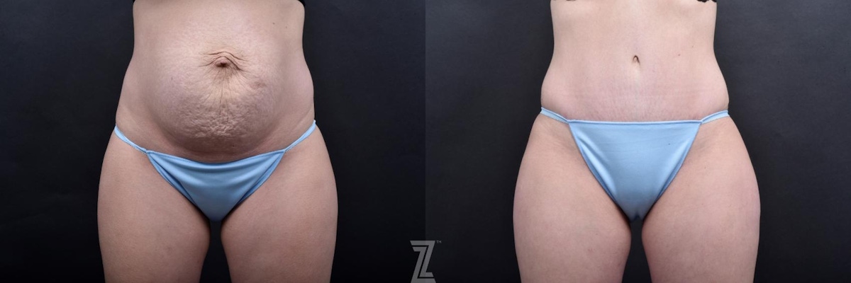 Austin Tummy Tuck Before & After Gallery - Patient 132886793 - Image 1 - The Piazza Center