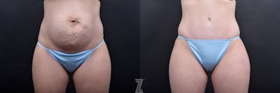 Austin Tummy Tuck Before & After Gallery - Patient 132886793 - Image 1 - The Piazza Center