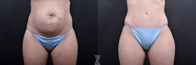 Tummy Tuck Before & After Gallery - Patient 132886793 - Image 1