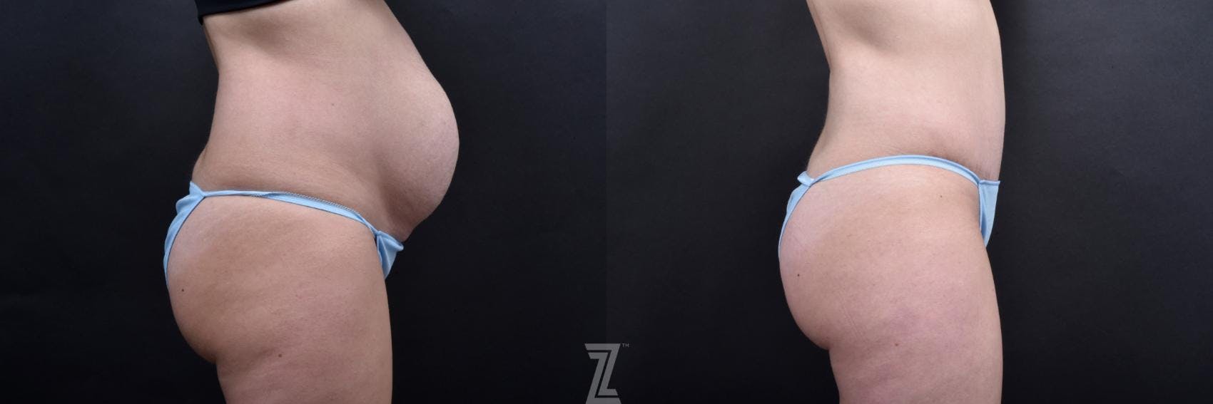 Tummy Tuck Before & After Gallery - Patient 132886793 - Image 4