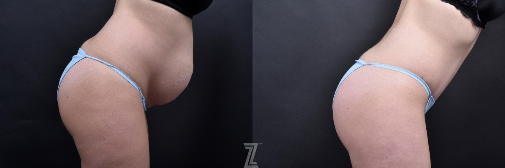Tummy Tuck Before & After Gallery - Patient 132886793 - Image 5