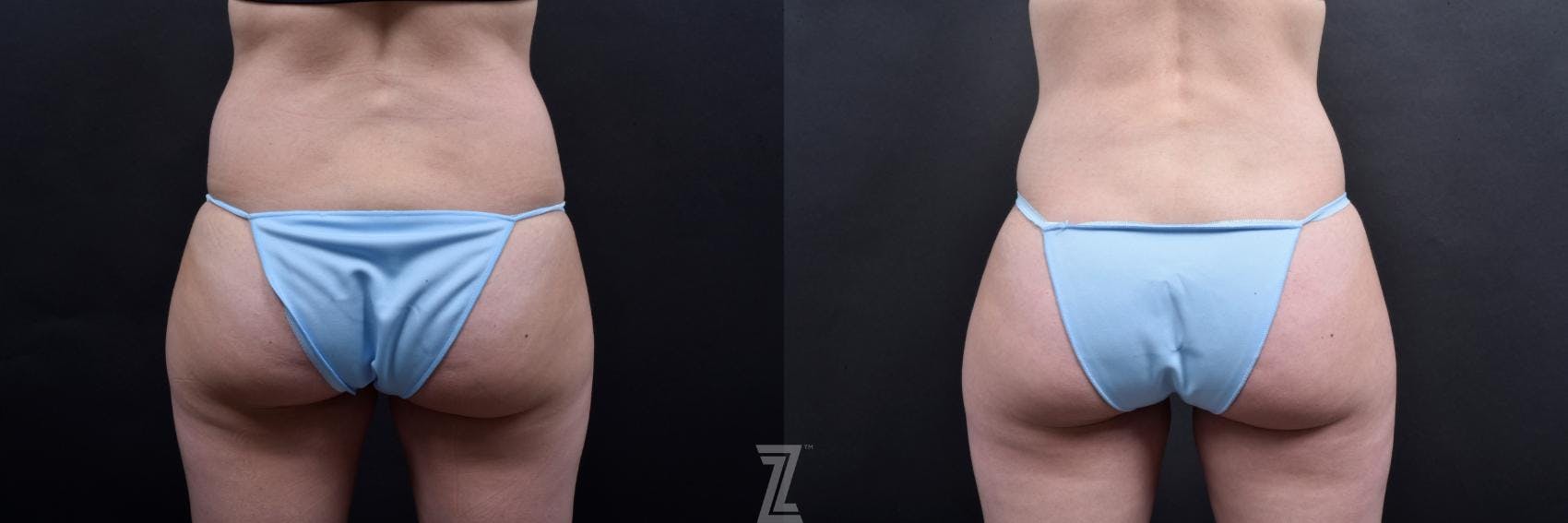 Tummy Tuck Before & After Gallery - Patient 132886793 - Image 6