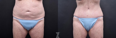 Tummy Tuck Before & After Gallery - Patient 132886796 - Image 1