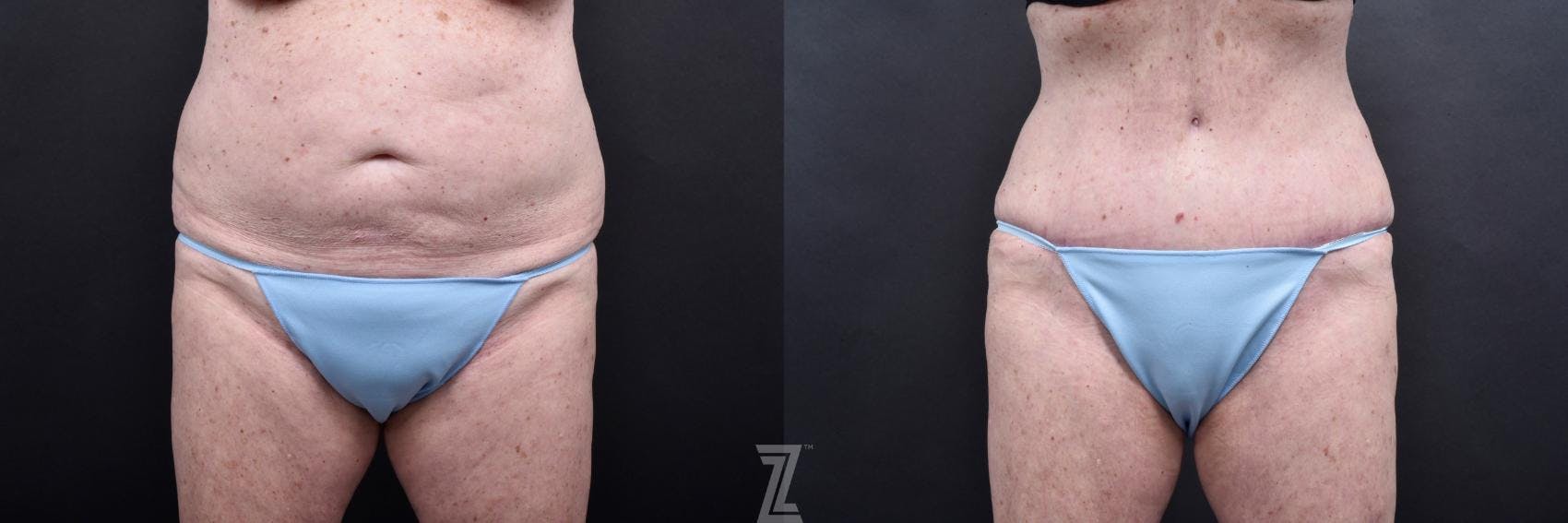 Tummy Tuck Before & After Gallery - Patient 132886796 - Image 1