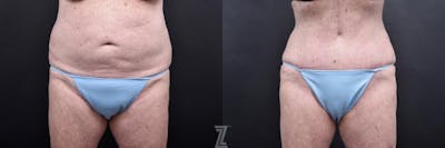 Austin Tummy Tuck Before & After Gallery - Patient 132886796 - Image 1 - The Piazza Center