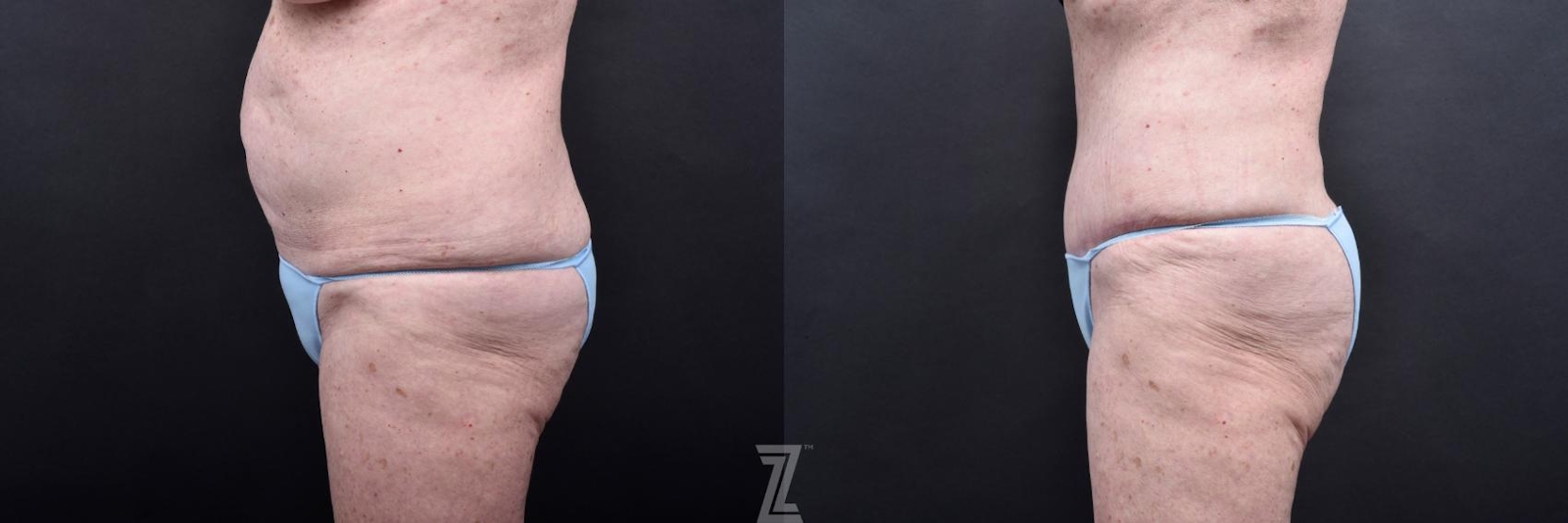 Austin Tummy Tuck Before & After Gallery - Patient 132886796 - Image 2 - The Piazza Center