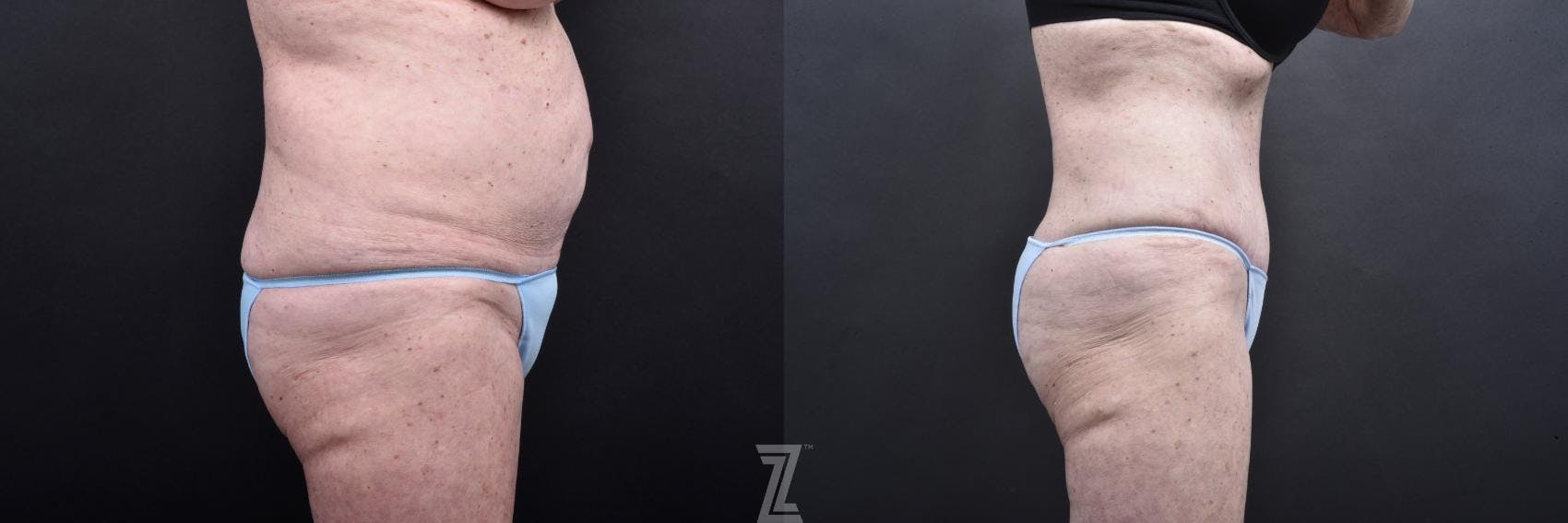 Tummy Tuck Before & After Gallery - Patient 132886796 - Image 3