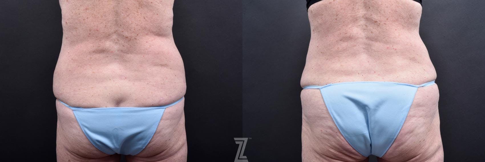 Tummy Tuck Before & After Gallery - Patient 132886796 - Image 4