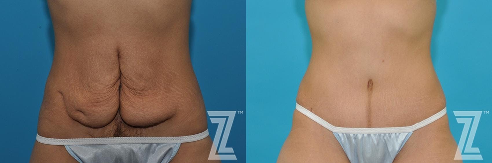Tummy Tuck Before & After Gallery - Patient 132886797 - Image 1
