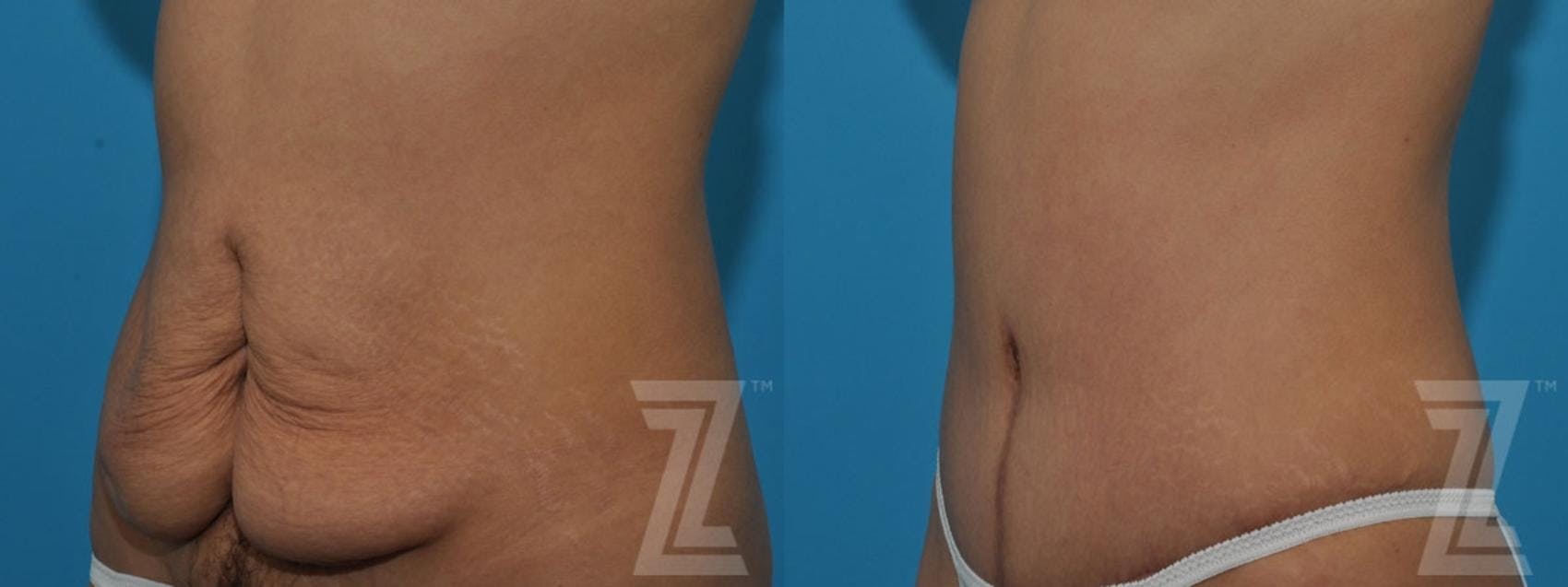 Tummy Tuck Before & After Gallery - Patient 132886797 - Image 2