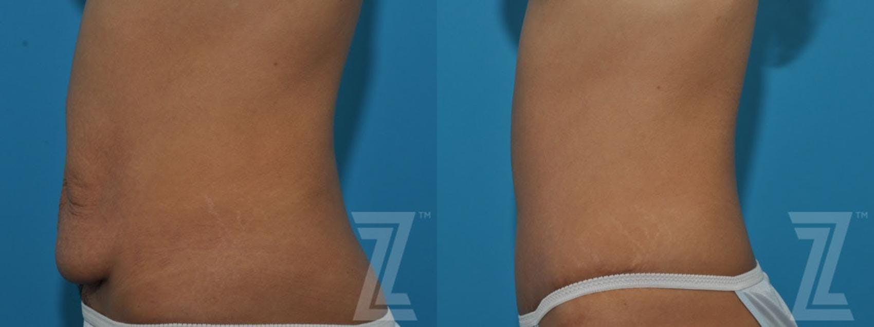 Tummy Tuck Before & After Gallery - Patient 132886797 - Image 3