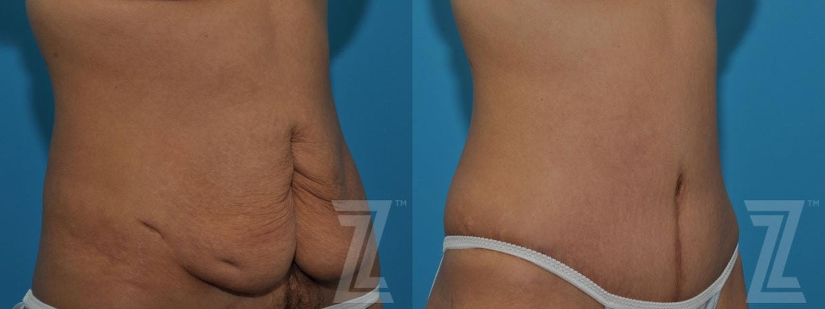 Tummy Tuck Before & After Gallery - Patient 132886797 - Image 4