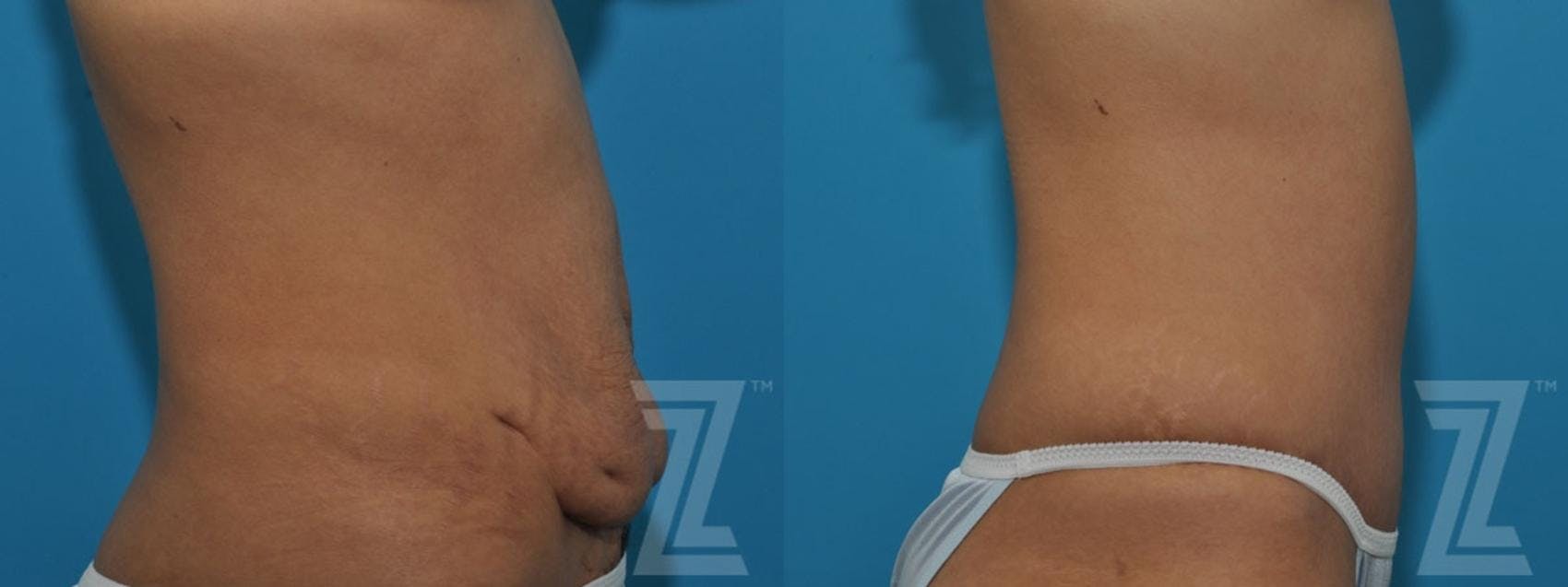 Tummy Tuck Before & After Gallery - Patient 132886797 - Image 5