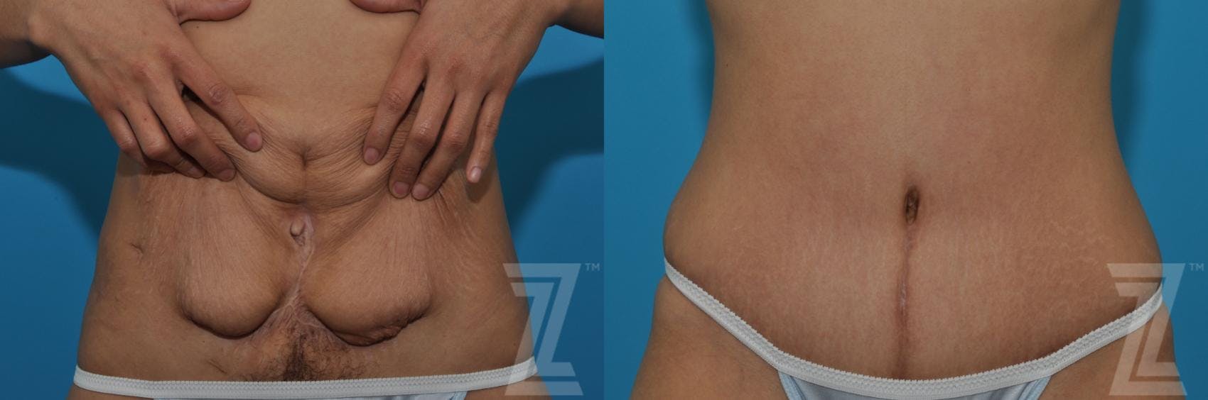Tummy Tuck Before & After Gallery - Patient 132886797 - Image 6