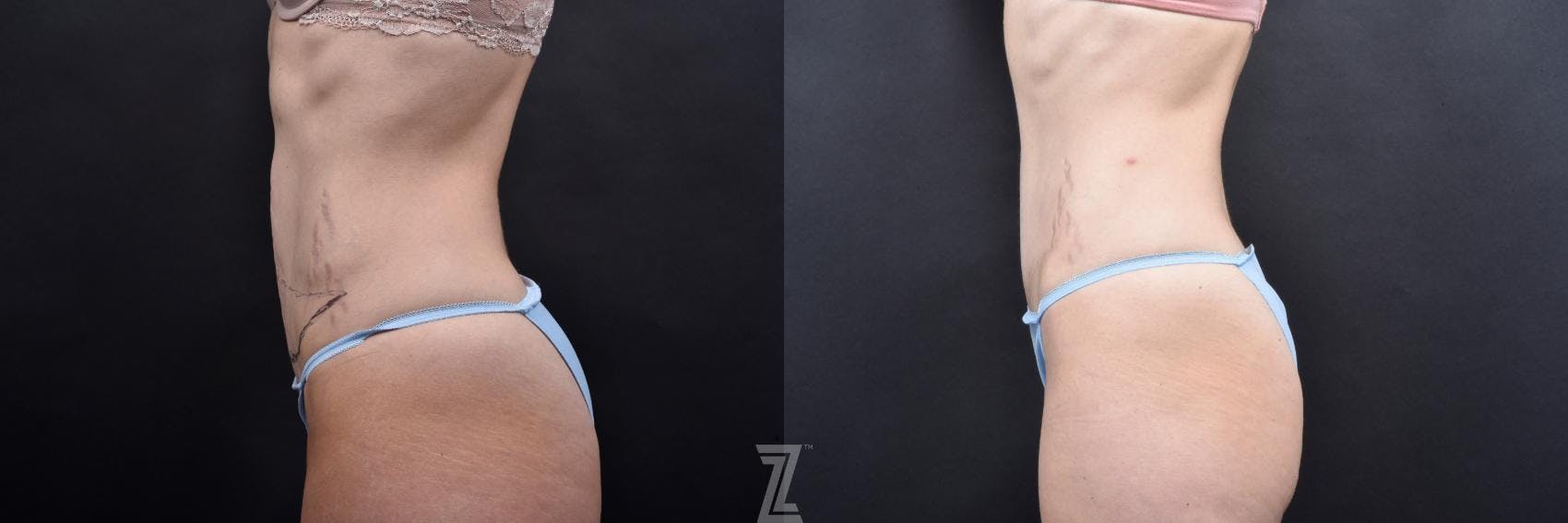 Tummy Tuck Before & After Gallery - Patient 132886798 - Image 2
