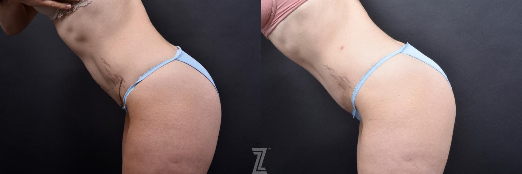 Tummy Tuck Before & After Gallery - Patient 132886798 - Image 3