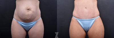 Tummy Tuck Before & After Gallery - Patient 132886800 - Image 1