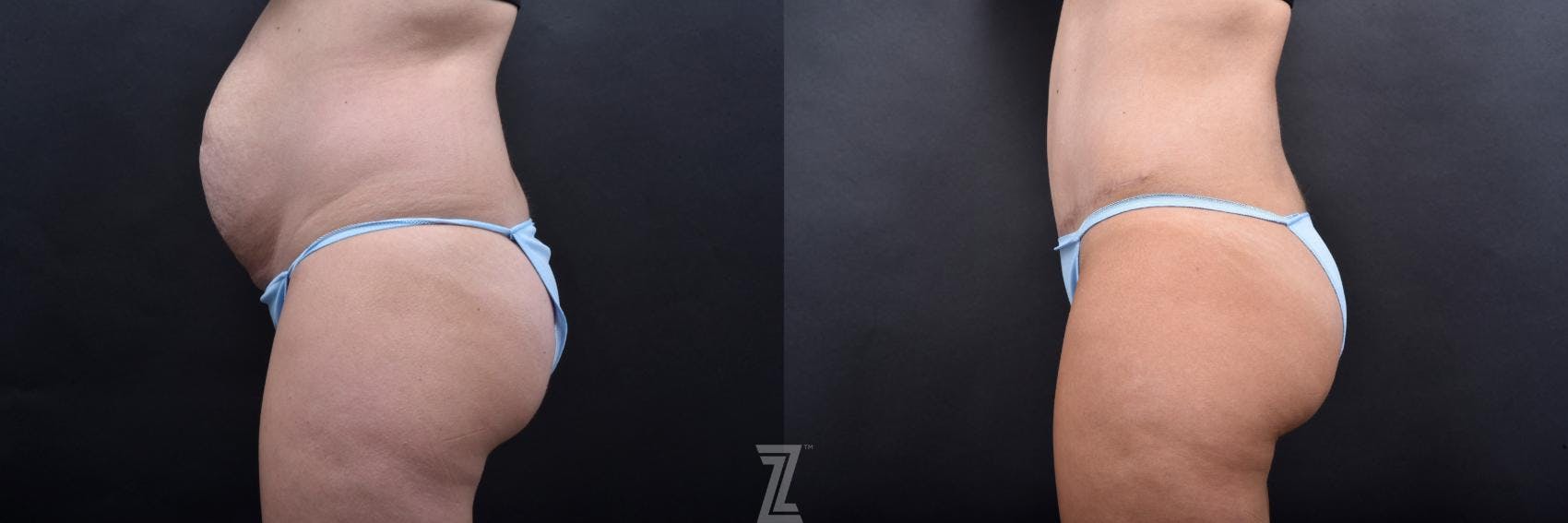 Tummy Tuck Before & After Gallery - Patient 132886800 - Image 2