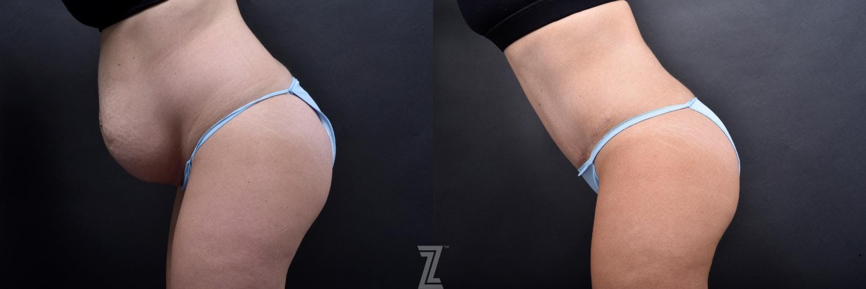 Tummy Tuck Before & After Gallery - Patient 132886800 - Image 3