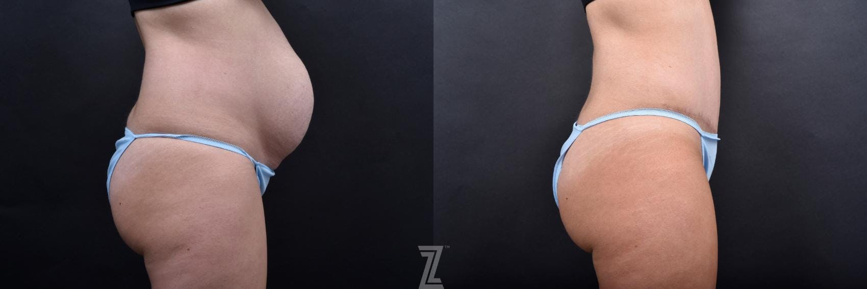 Tummy Tuck Before & After Gallery - Patient 132886800 - Image 4