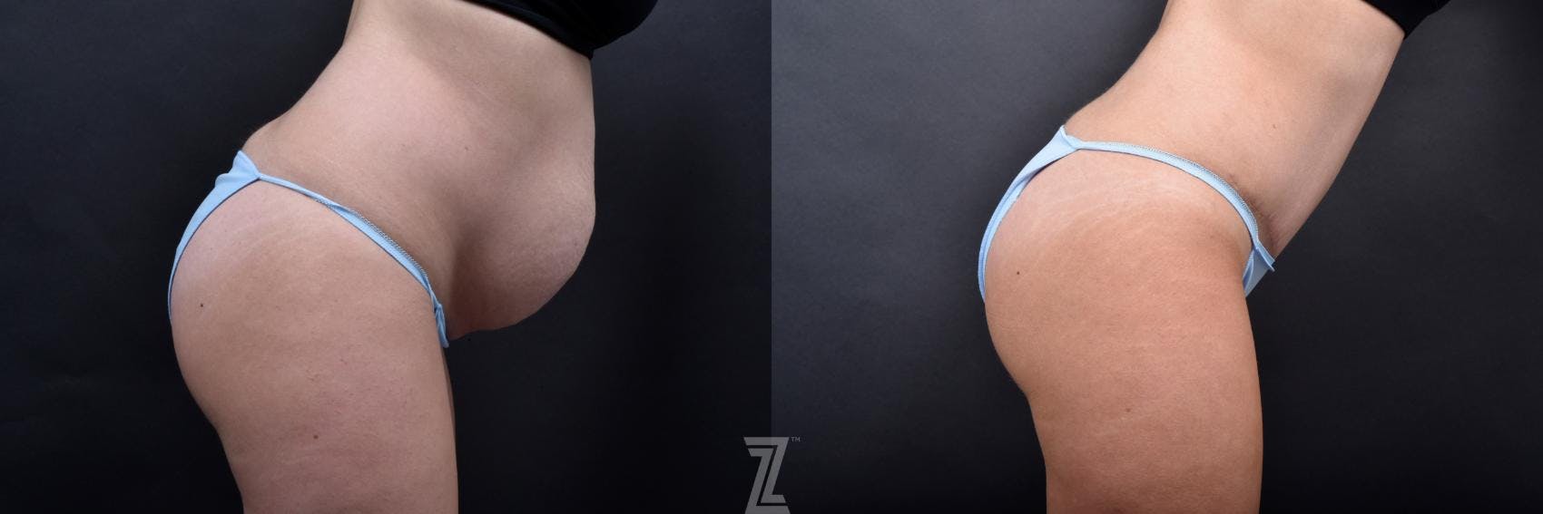Tummy Tuck Before & After Gallery - Patient 132886800 - Image 5