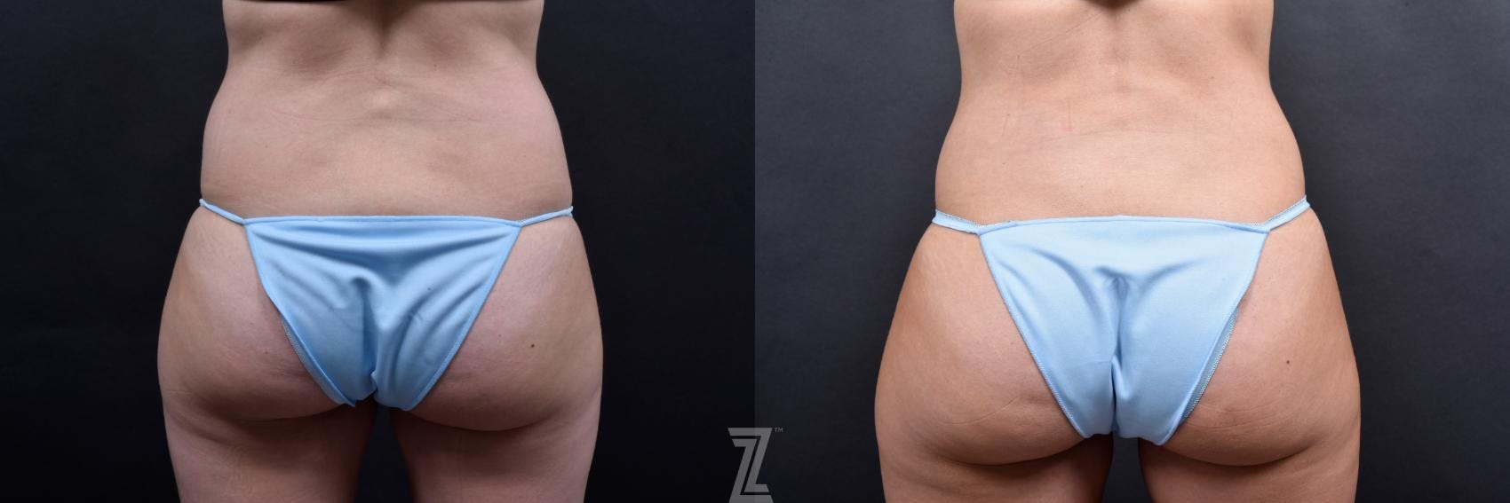 Tummy Tuck Before & After Gallery - Patient 132886800 - Image 6