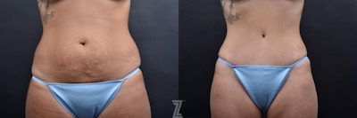 Tummy Tuck Before & After Gallery - Patient 132886801 - Image 1