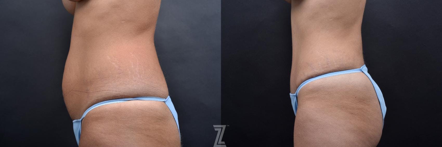 Tummy Tuck Before & After Gallery - Patient 132886801 - Image 2