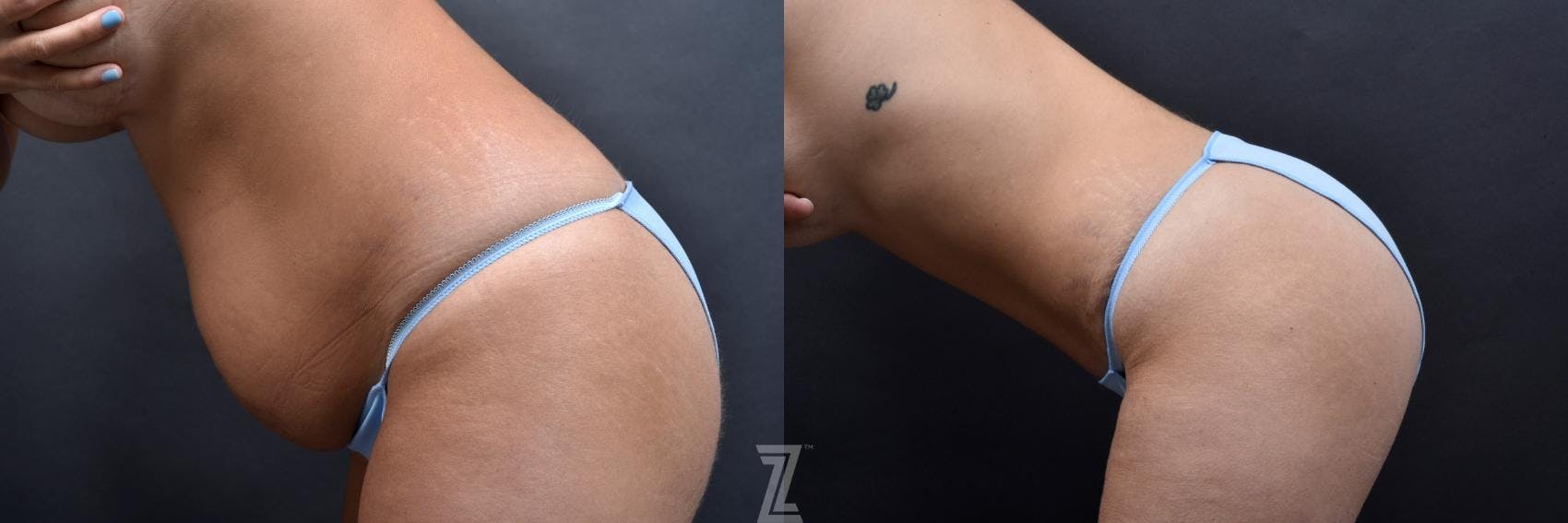 Tummy Tuck Before & After Gallery - Patient 132886801 - Image 3