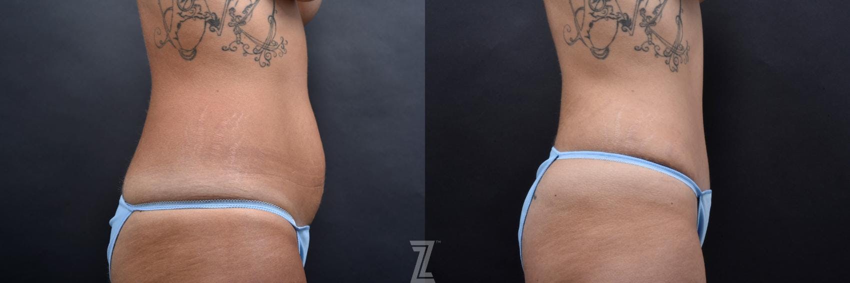 Tummy Tuck Before & After Gallery - Patient 132886801 - Image 4
