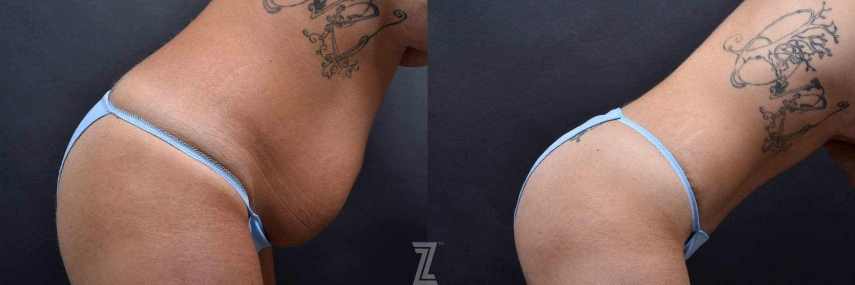 Tummy Tuck Before & After Gallery - Patient 132886801 - Image 5