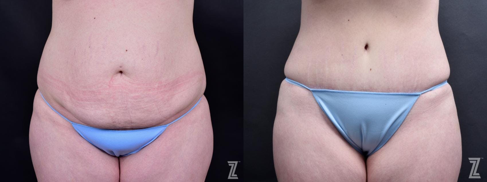Mons Pubis Reduction Before & After Gallery: Patient 2