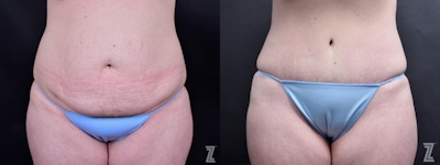 Tummy Tuck Before & After Gallery - Patient 132886803 - Image 1
