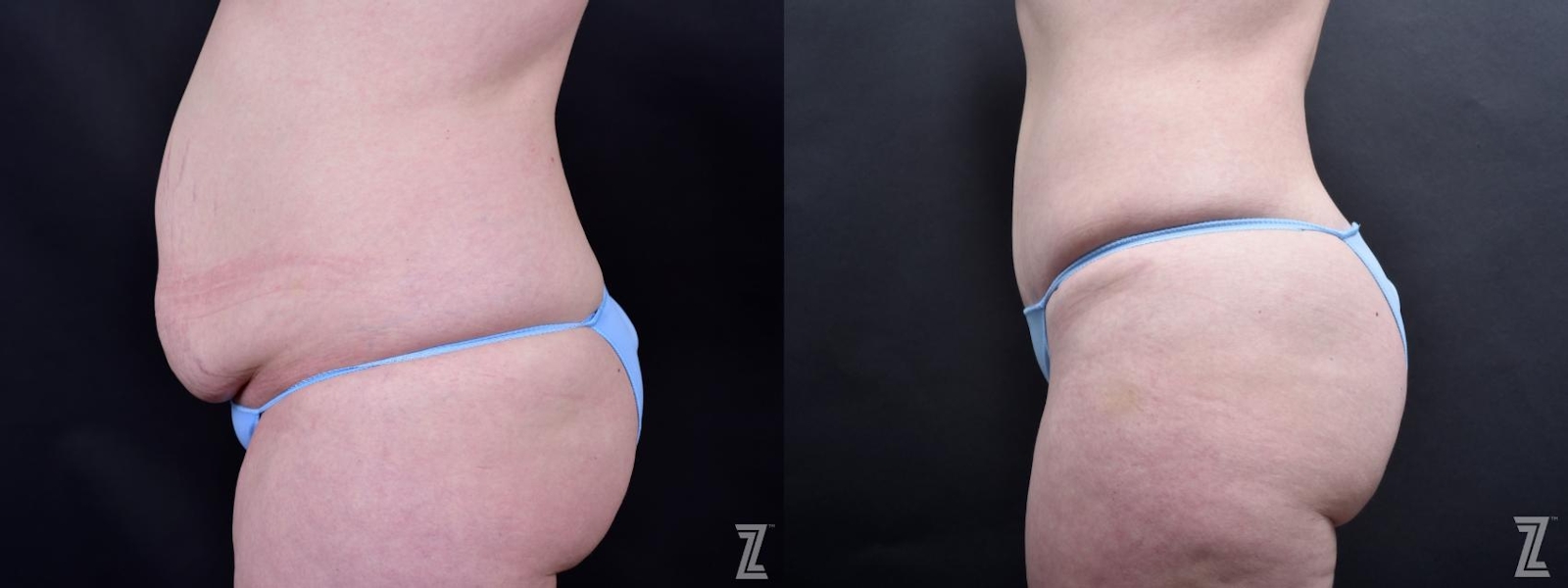Austin Tummy Tuck Before & After Gallery - Patient 132886803 - Image 2 - The Piazza Center