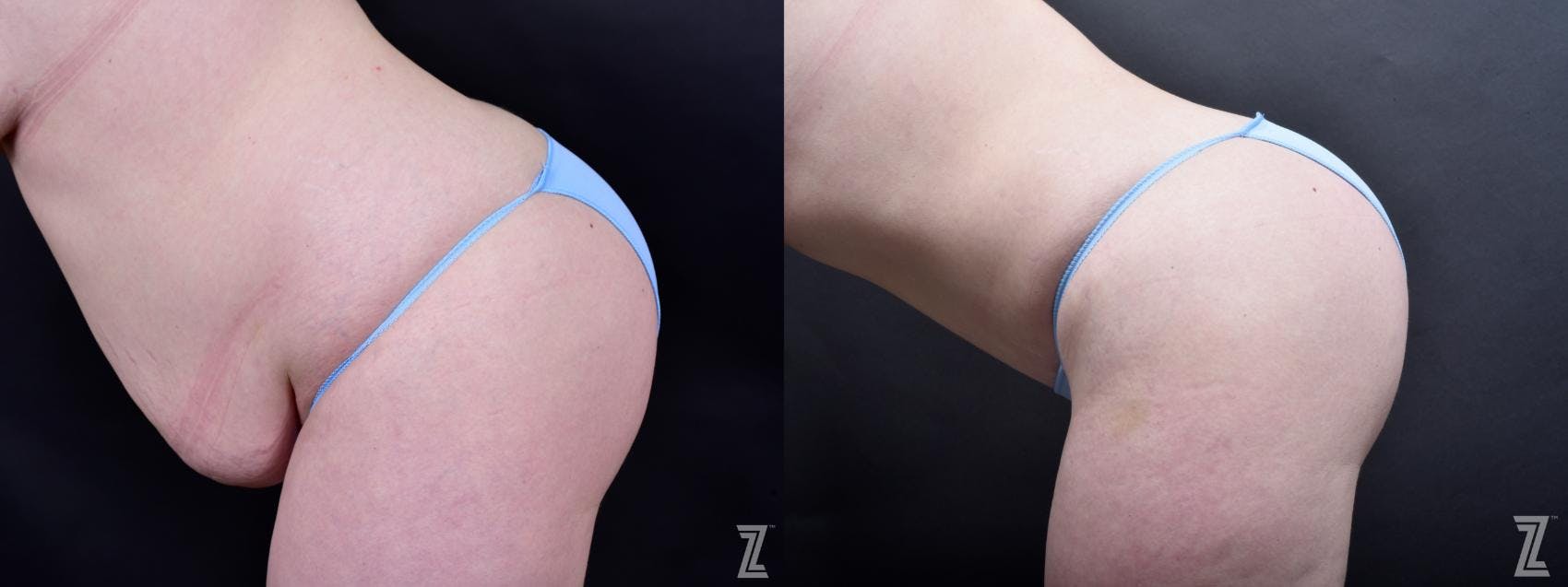 Tummy Tuck Before & After Gallery - Patient 132886803 - Image 3