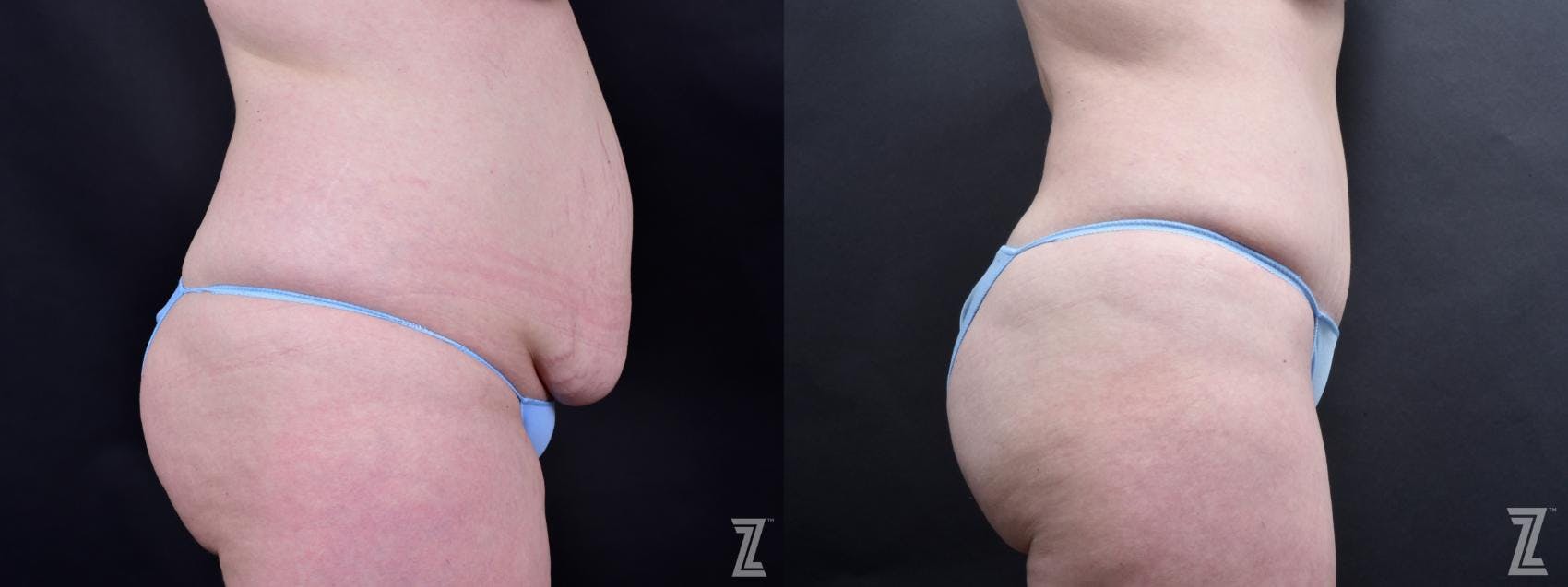 Tummy Tuck Before & After Gallery - Patient 132886803 - Image 4