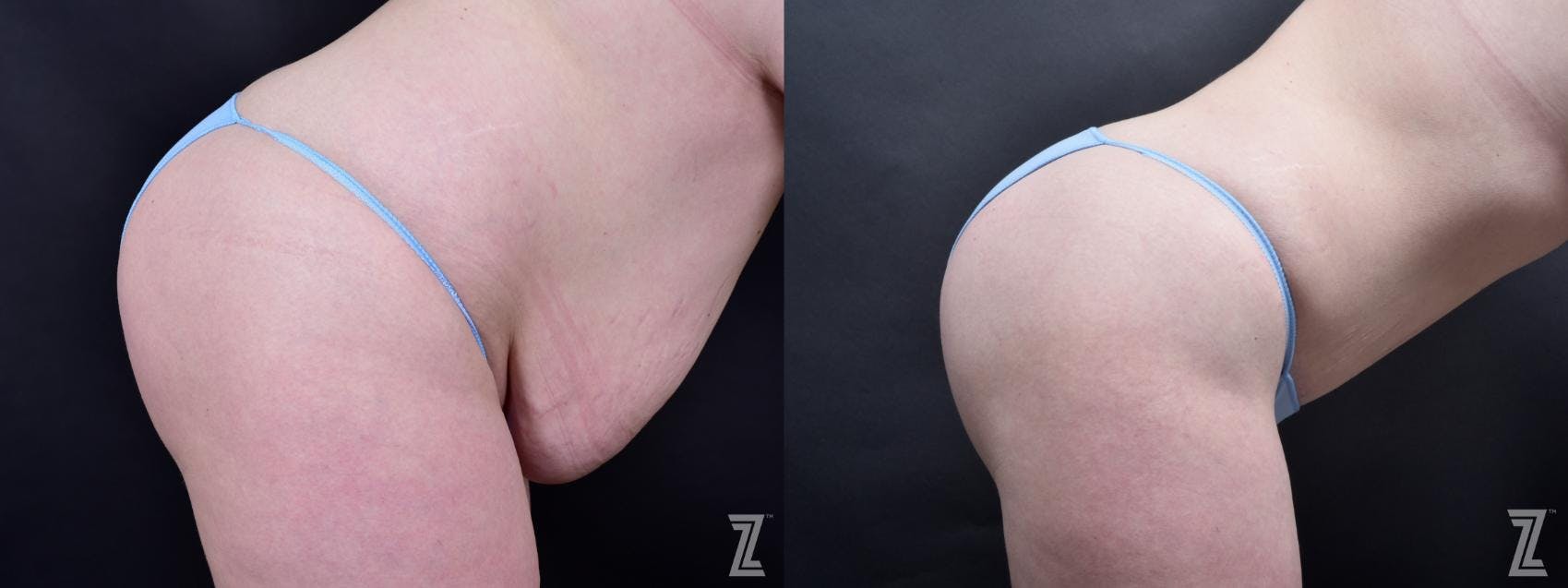 Tummy Tuck Before & After Gallery - Patient 132886803 - Image 5