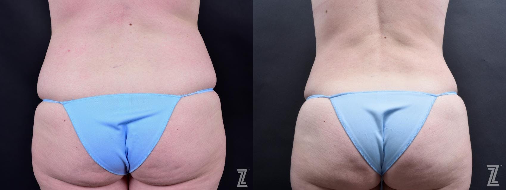 Tummy Tuck Before & After Gallery - Patient 132886803 - Image 6