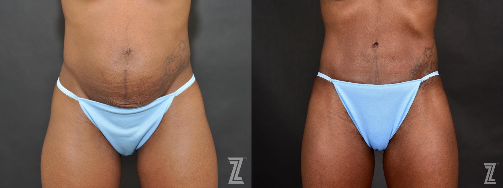 Tummy Tuck Before & After Gallery - Patient 132886804 - Image 1