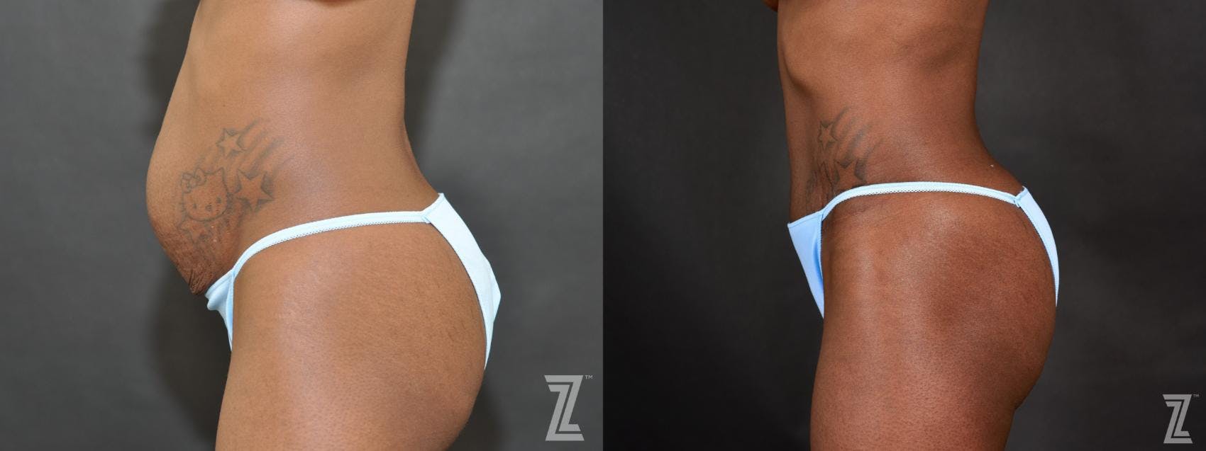 Tummy Tuck Before & After Gallery - Patient 132886804 - Image 2
