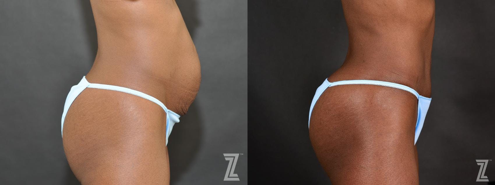 Tummy Tuck Before & After Gallery - Patient 132886804 - Image 3