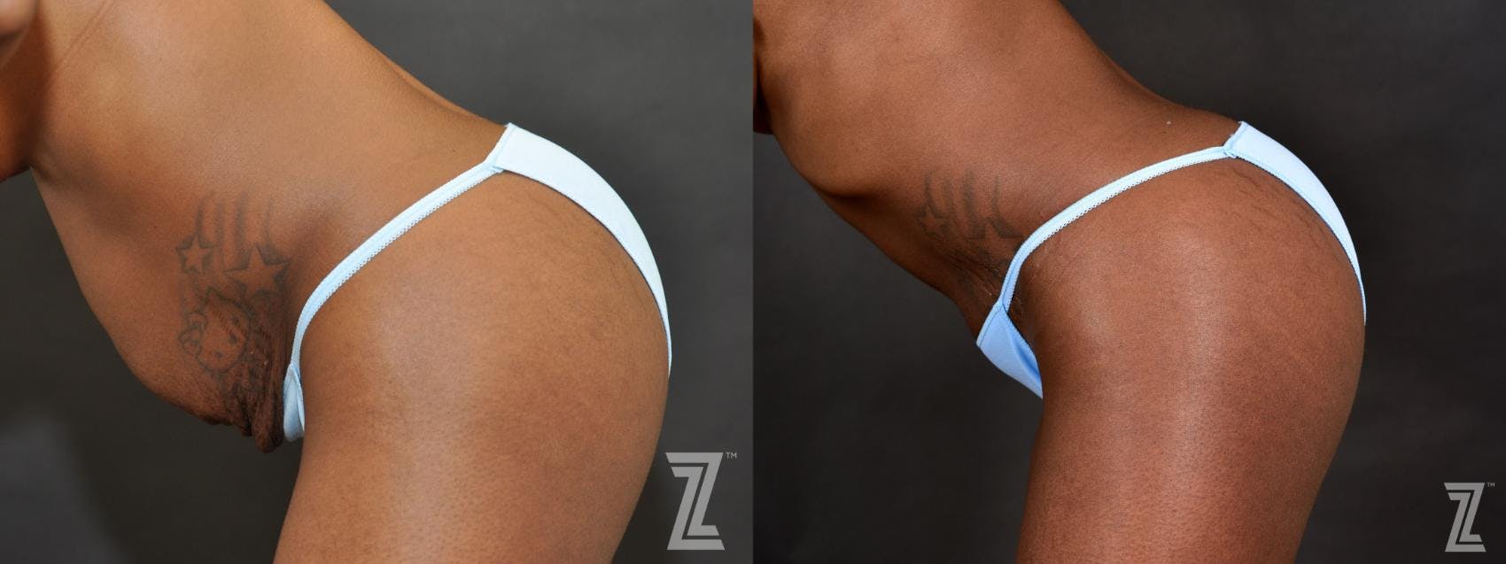 Tummy Tuck Before & After Gallery - Patient 132886804 - Image 4