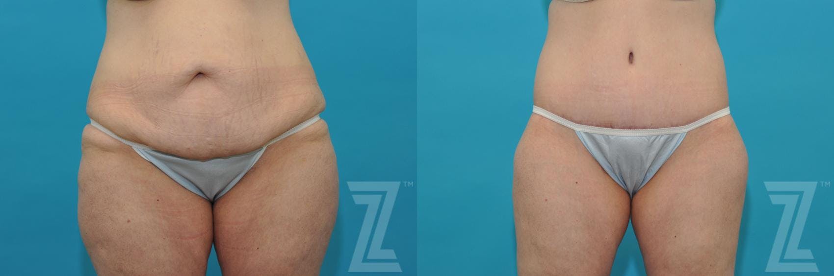 Tummy Tuck Before & After Gallery - Patient 132886807 - Image 1