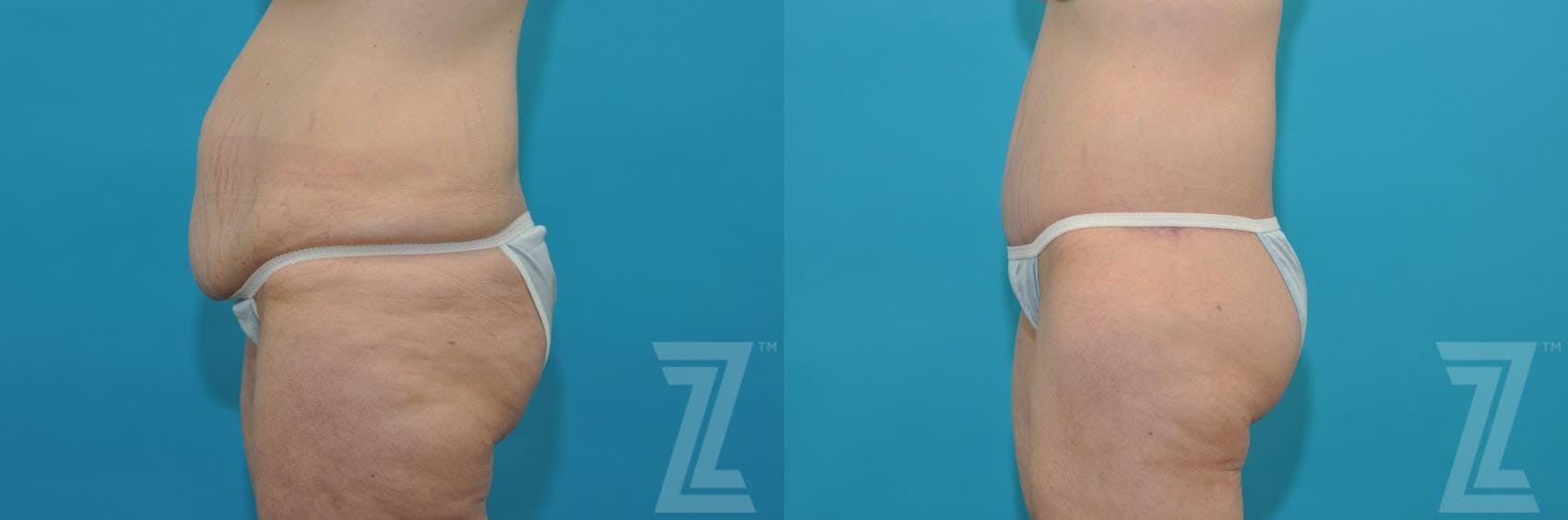 Tummy Tuck Before & After Gallery - Patient 132886807 - Image 2