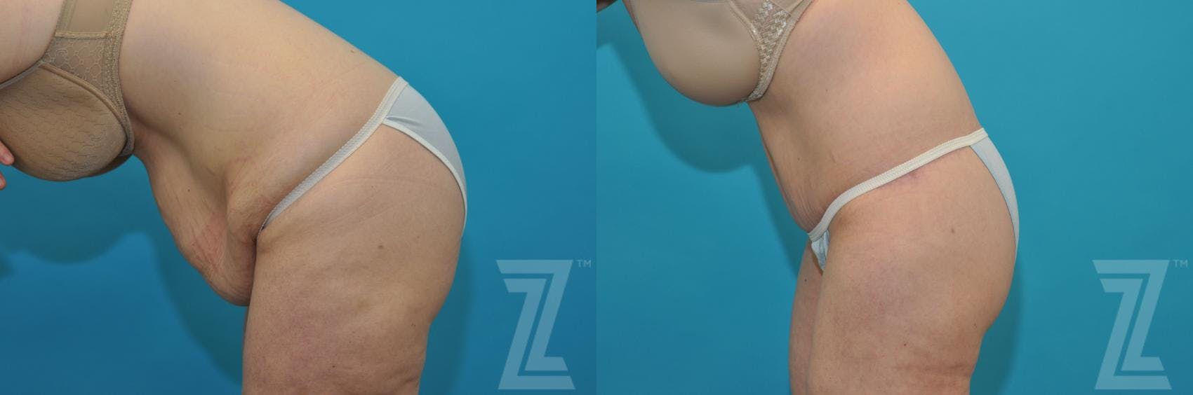 Tummy Tuck Before & After Gallery - Patient 132886807 - Image 3
