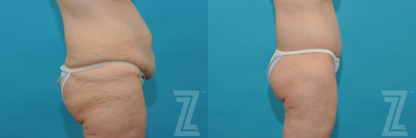Tummy Tuck Before & After Gallery - Patient 132886807 - Image 4
