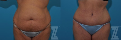 Tummy Tuck Before & After Gallery - Patient 132886809 - Image 1