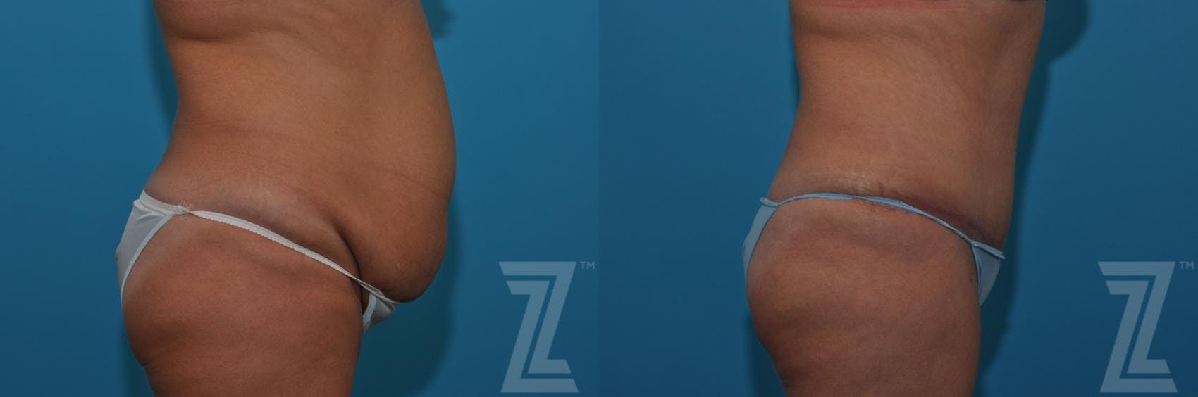 Tummy Tuck Before & After Gallery - Patient 132886809 - Image 3