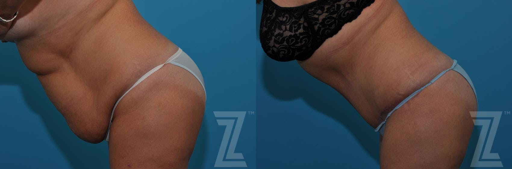 Tummy Tuck Before & After Gallery - Patient 132886809 - Image 4