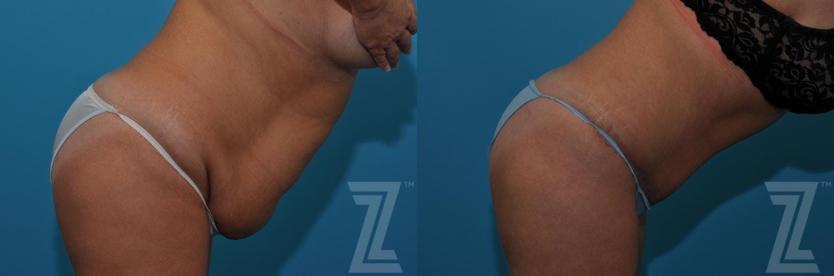 Tummy Tuck Before & After Gallery - Patient 132886809 - Image 5